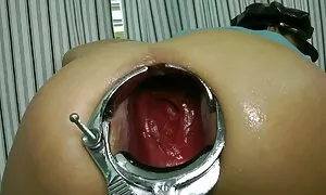 Speculum prolapse a  ...